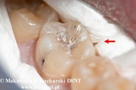 Próchnica w zębie trzonowym dolnym